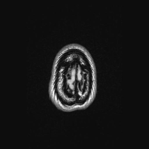 Atretic encephalocoele with inferior vermis hypoplasia (Radiopaedia 30443-31108 Axial 146).jpg