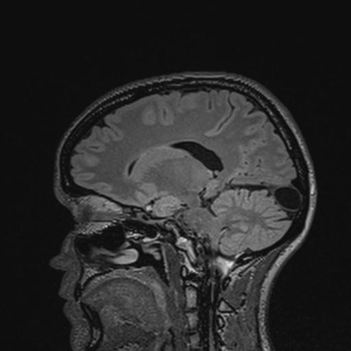 Atretic encephalocoele with inferior vermis hypoplasia (Radiopaedia 30443-31108 Sagittal FLAIR 95).jpg
