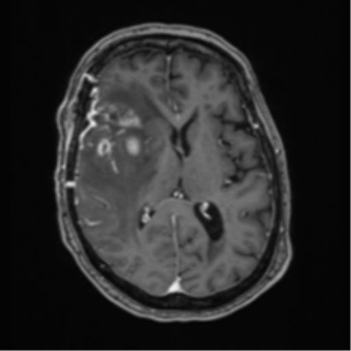 File:Atypical meningioma (WHO Grade II) (Radiopaedia 54742-60981 Axial T1 C+ 37).png