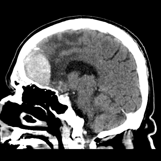 Atypical meningioma (WHO grade II) with brain invasion (Radiopaedia 57767-64728 Sagittal C+ 23).png