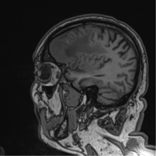 Atypical meningioma (WHO grade II) with brain invasion (Radiopaedia 57767-64729 Sagittal T1 49).png