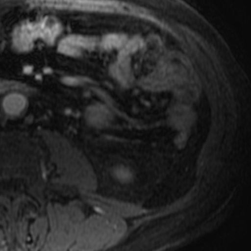 File:Atypical renal cyst on MRI (Radiopaedia 17349-17046 D 31).jpg