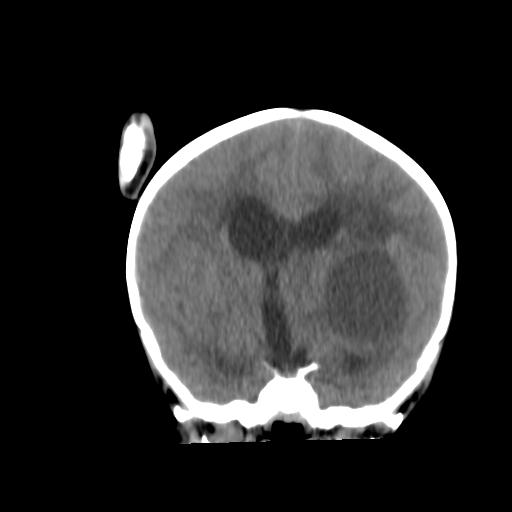Atypical teratoid rhabdoid tumor (AT-RT) (Radiopaedia 85823-101654 Coronal non-contrast 23).jpg