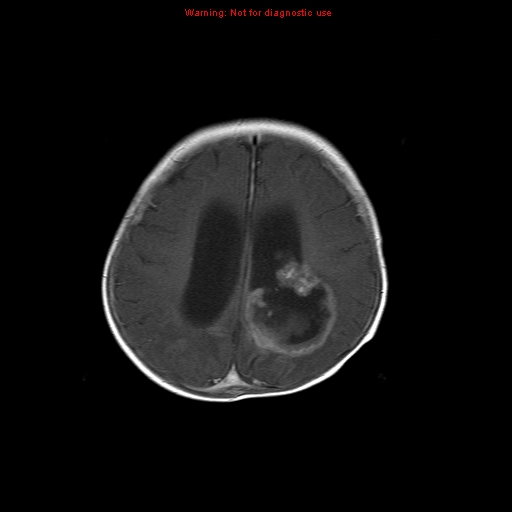 File:Atypical teratoid rhabdoid tumor (Radiopaedia 10712-11183 Axial T1 C+ 5).jpg