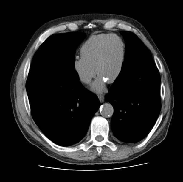 Autosomal dominant polycystic kidney disease (Radiopaedia 27851-28094 Axial non-contrast 39).jpg