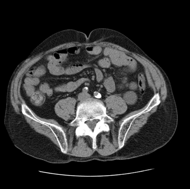 Autosomal dominant polycystic kidney disease (Radiopaedia 27851-28094 Axial non-contrast 87).jpg