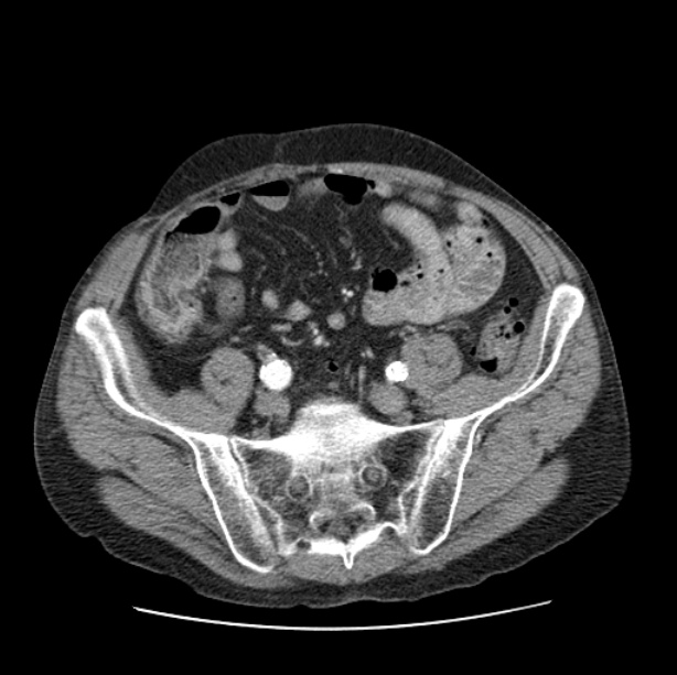 Autosomal dominant polycystic kidney disease (Radiopaedia 27851-28094 B 97).jpg