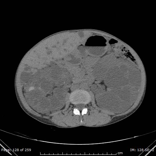 File:Autosomal dominant polycystic kidney disease (Radiopaedia 44122-47684 Axial 3).jpg