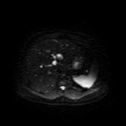 File:Autosomal dominant polycystic kidney disease (Radiopaedia 50259-55611 Axial DWI 11).jpg