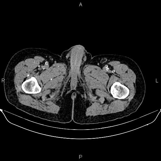 File:Autosomal dominant polycystic kidney disease (Radiopaedia 87830-104287 Axial non-contrast 61).jpg