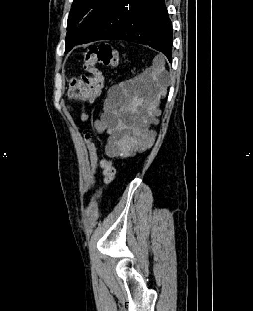 Autosomal dominant polycystic kidney disease (Radiopaedia 87830-104287 C 79).jpg