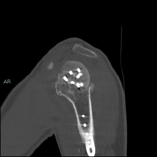 Avascular necrosis after fracture dislocations of the proximal humerus (Radiopaedia 88078-104653 Sagittal bone window 23).jpg