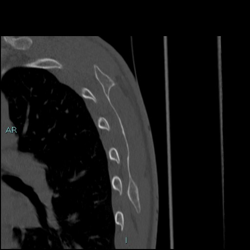 Avascular necrosis after fracture dislocations of the proximal humerus (Radiopaedia 88078-104653 Sagittal bone window 82).jpg