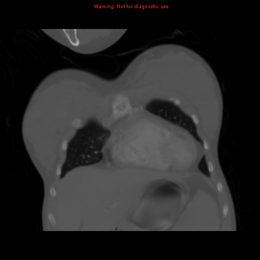 Avascular necrosis in sickle cell disease (Radiopaedia 17448-17152 Coronal bone window 23).jpg