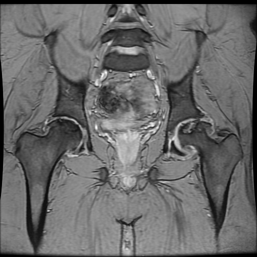 Avascular necrosis of the hip (Radiopaedia 61503-69465 F 56).jpg