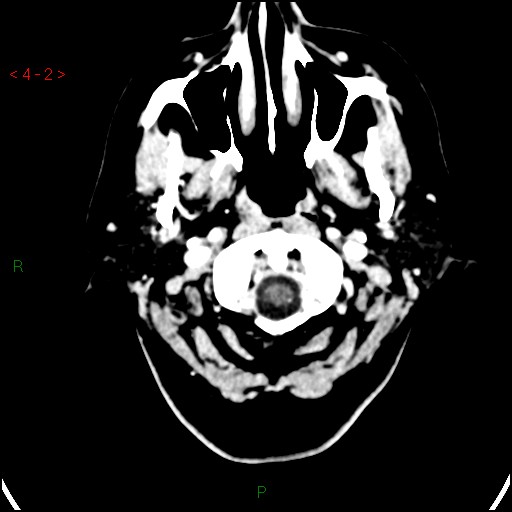 Azygos anterior cerebral artery (Radiopaedia 51987-57833 A 2).jpg