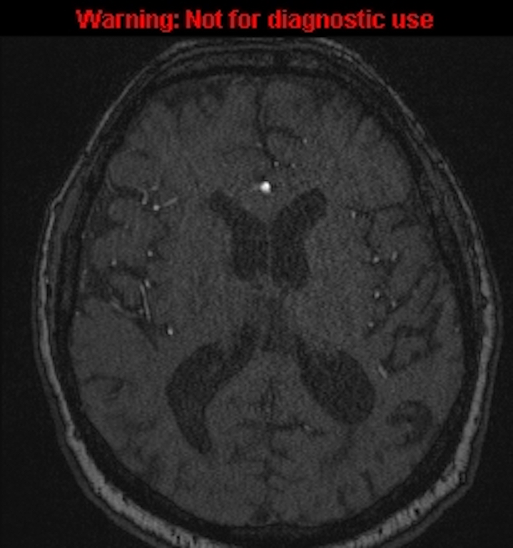 Azygos anterior cerebral artery (Radiopaedia 59325-66677 Axial MRA 99).jpg