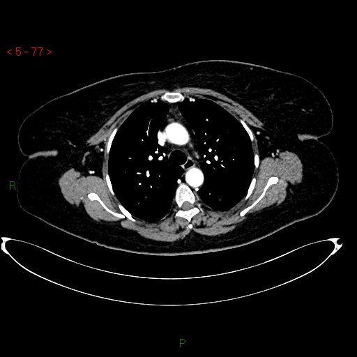 Azygos fissure and lobe (Radiopaedia 47620-52278 A 63).jpg