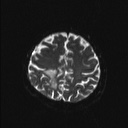 Balo concentric sclerosis (Radiopaedia 50458-55940 Axial DWI 6).jpg