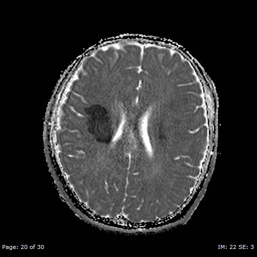Balo concentric sclerosis (Radiopaedia 61637-69636 I 120).jpg