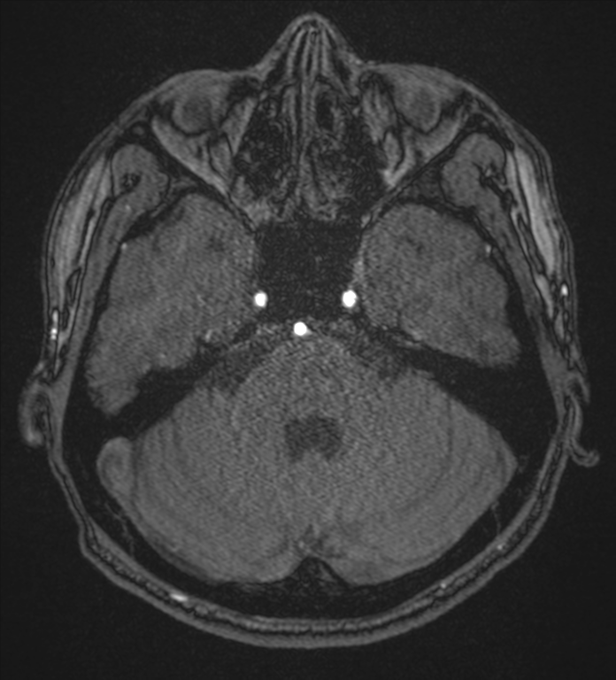 Basal ganglia subacute infarct (Radiopaedia 80201-93521 Axial MRA 22).png
