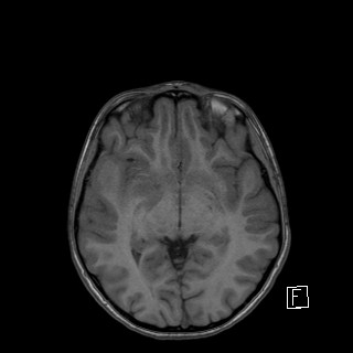 Base of skull rhabdomyosarcoma (Radiopaedia 32196-33142 Axial T1 24).jpg