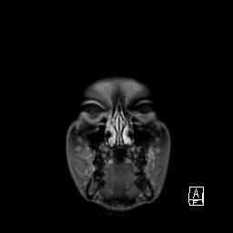 Base of skull rhabdomyosarcoma (Radiopaedia 32196-33142 I 13).jpg