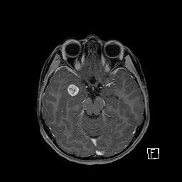 Base of skull rhabdomyosarcoma (Radiopaedia 32196-33142 T1 C+ fat sat 38).jpg