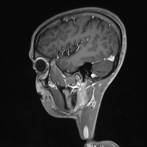 Basilar artery perforator aneurysm (Radiopaedia 82455-97733 G 35).jpg
