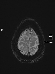 Basilar artery perforator aneurysm (Radiopaedia 82455-99523 Axial SWI 62).jpg