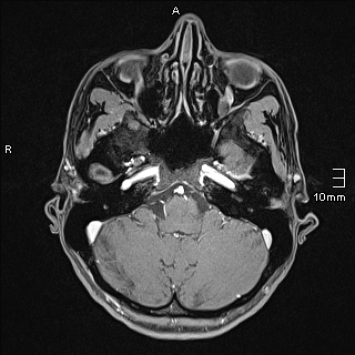 Basilar artery perforator aneurysm (Radiopaedia 82455-99523 G 22).jpg