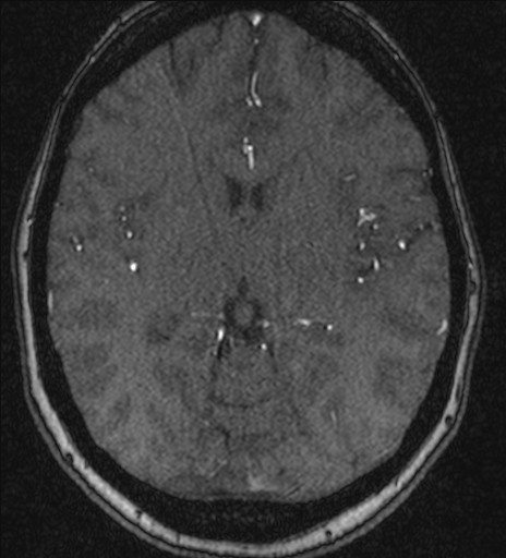 Basilar tip aneurysm (Radiopaedia 26504-26632 MRA 127).jpg