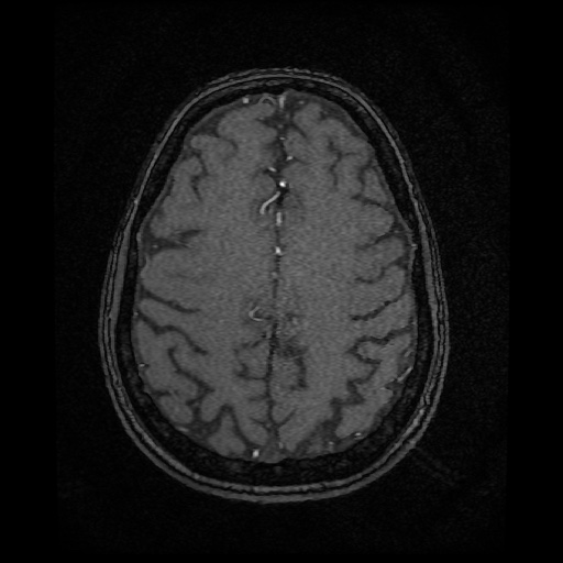 Basilar top and left middle cerebral artery aneurysm (Radiopaedia 61965-70031 Axial MRA 129).jpg