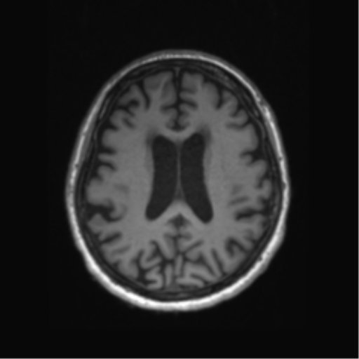 Behavioral variant frontotemporal dementia and late onset schizophrenia (Radiopaedia 52197-58083 Axial T1 35).png
