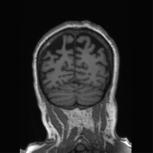 Behavioral variant frontotemporal dementia and late onset schizophrenia (Radiopaedia 52197-58083 Coronal T1 26).png