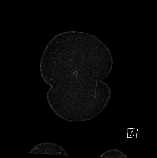 Below filter IVC thrombosis (Radiopaedia 58187-65266 B 14).jpg
