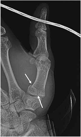File:Bennett fracture1.png