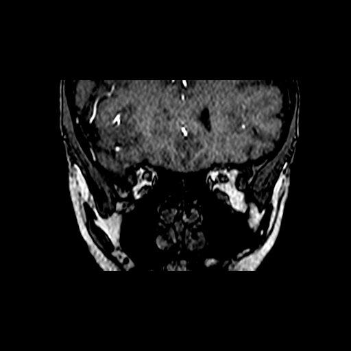 Berry aneurysm of the terminal internal carotid artery (Radiopaedia 88286-104918 Coronal TOF 14).jpg