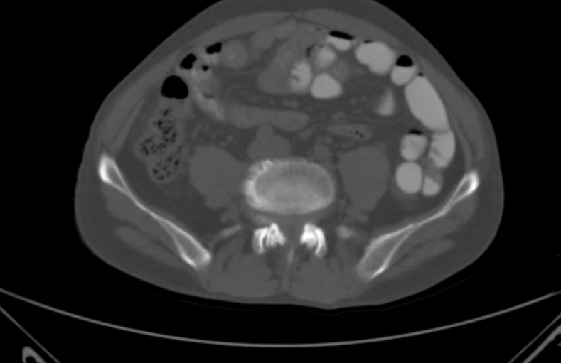 File:Bertolotti syndrome (Radiopaedia 58974-66235 Axial bone window 16).jpg