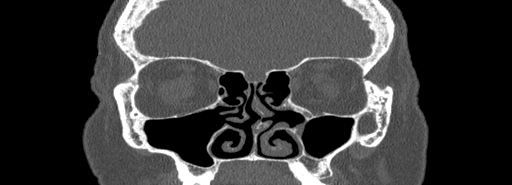 Bilateral Ectopic Infraorbital Nerves (Radiopaedia 49006-54084 Coronal bone window 30).jpg