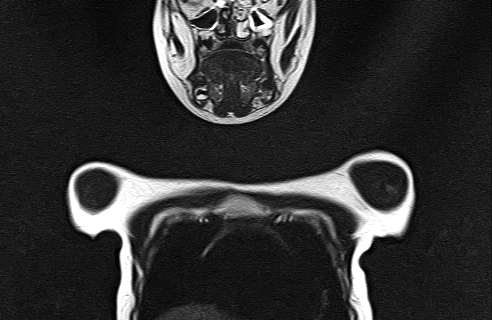 File:Bilateral Sprengel deformity with Klippel-Feil syndrome (Radiopaedia 66395-75650 Coronal T2 2).jpg