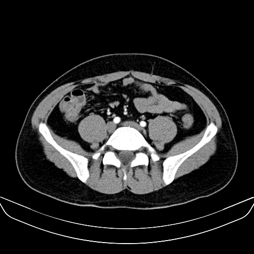 File:Bilateral accessory renal arteries with mild pelvi-ureteric junction (PUJ) obstruction (Radiopaedia 66357-75596 A 46).jpg