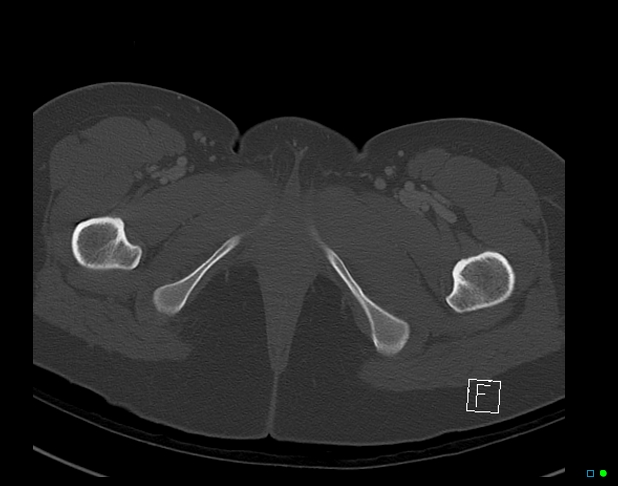 Bilateral acetabular fractures (Radiopaedia 79272-92308 Axial bone window 63).jpg