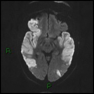 File:Bilateral acute middle cerebral artery territory infarcts (Radiopaedia 77319-89402 Axial DWI 35).jpg