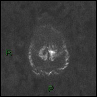 File:Bilateral acute middle cerebral artery territory infarcts (Radiopaedia 77319-89402 Axial DWI 47).jpg