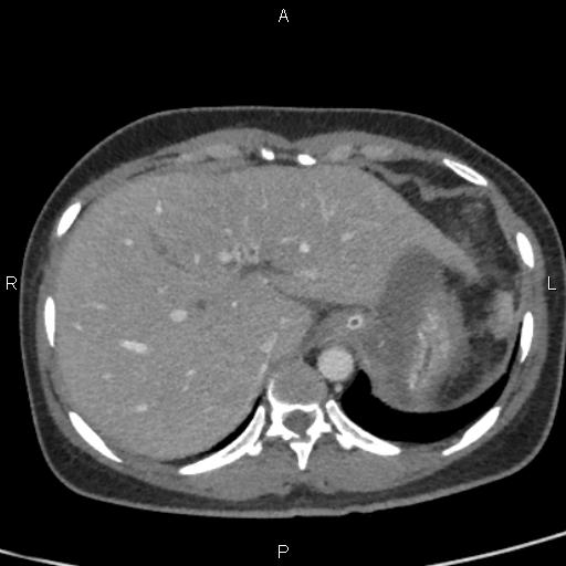 File:Bilateral adrenal gland hyperenhancement in pancreatitis (Radiopaedia 86642-102753 E 17).jpg