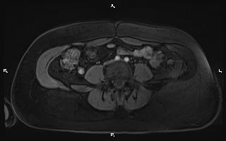 Bilateral adrenal myelolipoma (Radiopaedia 63058-71537 Axial T1 C+ fat sat 75).jpg