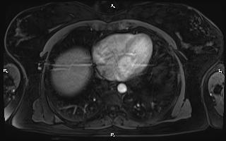 Bilateral adrenal myelolipoma (Radiopaedia 63058-71537 Axial T1 C+ fat sat 8).jpg