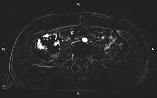 Bilateral adrenal myelolipoma (Radiopaedia 63058-71537 I 70).jpg