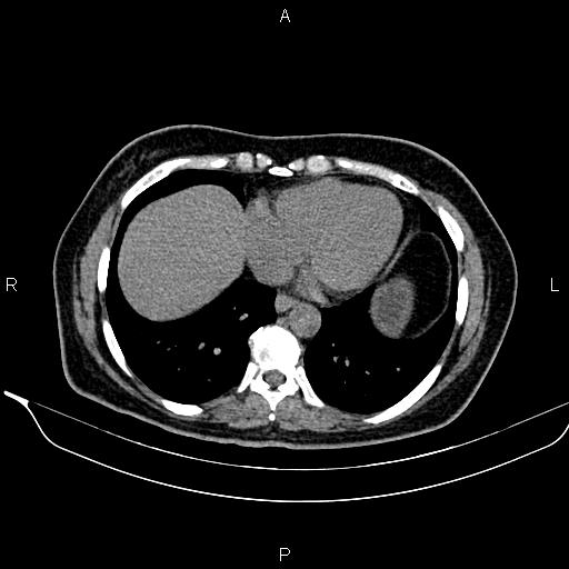 Bilateral benign adrenal adenomas (Radiopaedia 86912-103124 Axial non-contrast 13).jpg